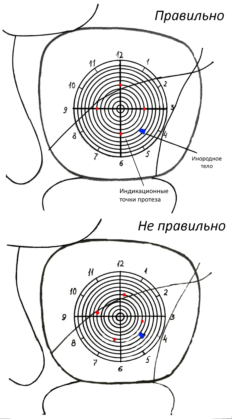 Схема фронтального снимка левой орбиты с наложенным на него измерительным шаблоном 