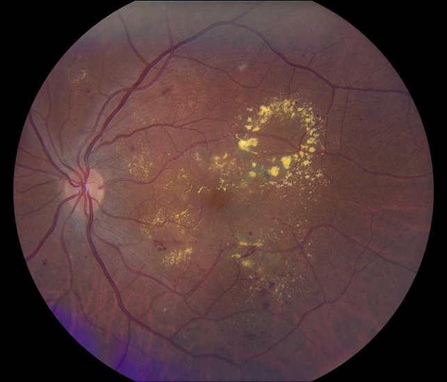 Непролиферативная стадия диабетической ретинопатии