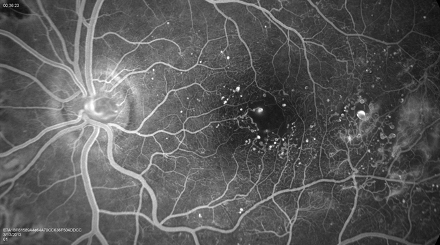 Пролиферативная диабетическая ретинопатия. Макулярный отек,микроаневризмы и неоваскуляризация. 