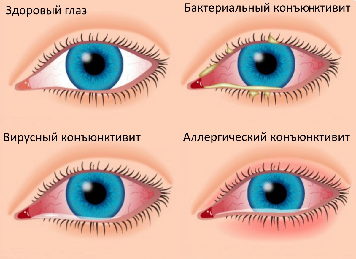 Синдром "красного глаза"