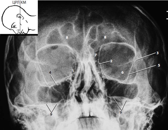 Рентгенограмма глазниц в прямой проекции (носоподбородочная укладка по Caldwell)