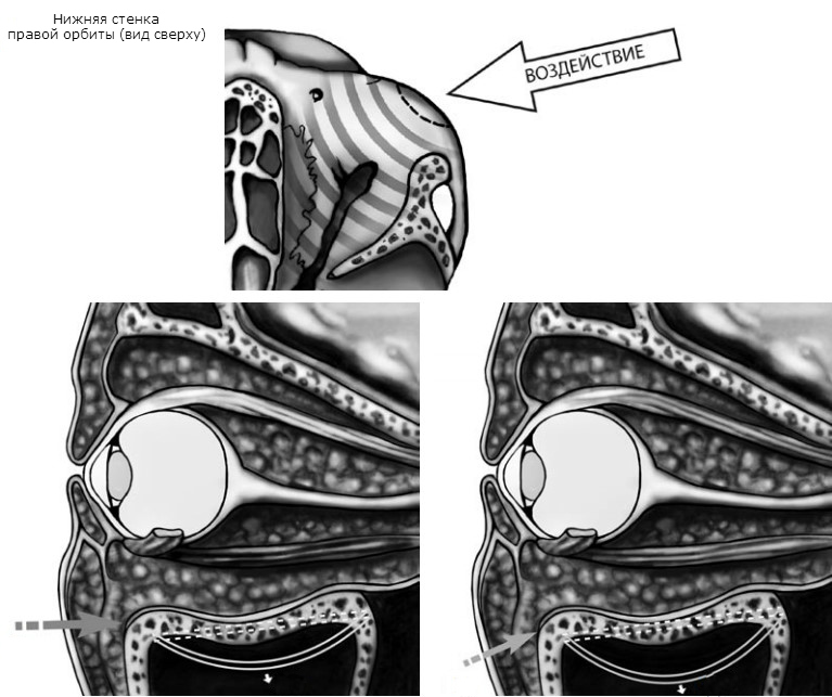 «Механическая» (buckling) теория возникновения перелома нижней стенки  глазницы