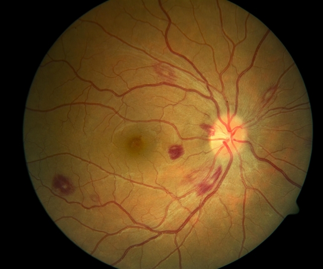 Пятна Рота при лейкемической ретинопатии