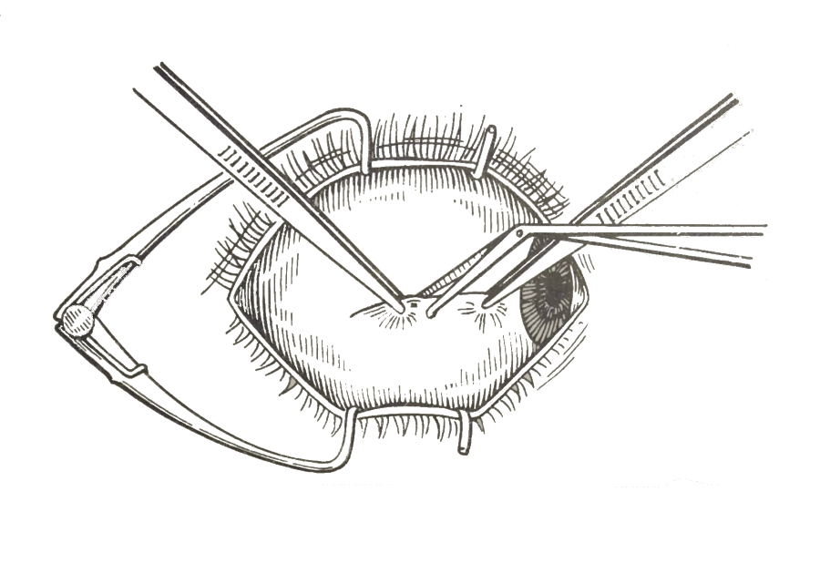 Разрез конъюнктивы и влагалища глазного яблока (схема)