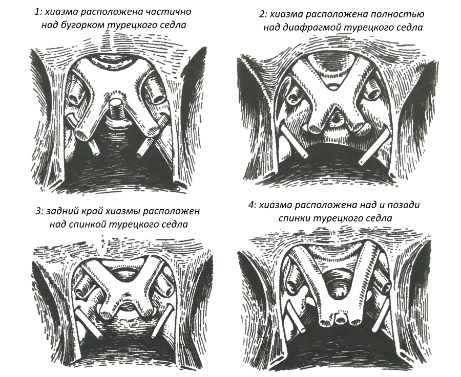 Анатомические варианты расположения хиазмы (по Трону Е.Ж.)