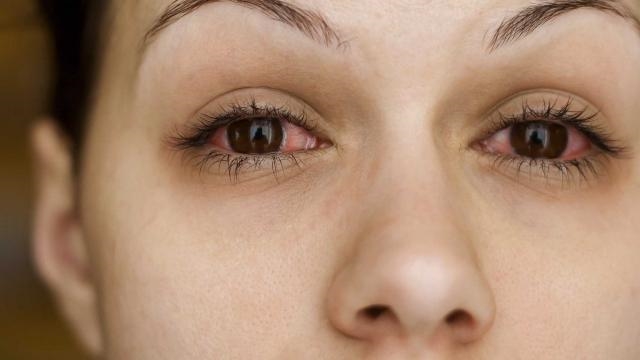 "Красный глаз" при синдроме Шегрена
