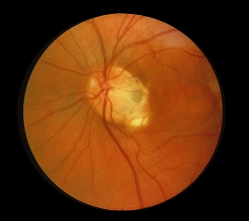 Аномалия развития зрительного нерва. Ямка ДЗН зрительного нерва. Колобома сетчатки глаза. Колобома диска зрительного нерва.