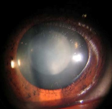 Зонулярная катаракта