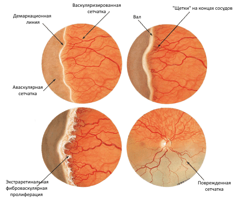 Стадии ретинопатии недоношенных