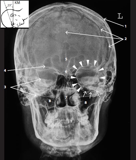 Рентгенограмма черепа в передней прямой проекции (носолобная укладка)