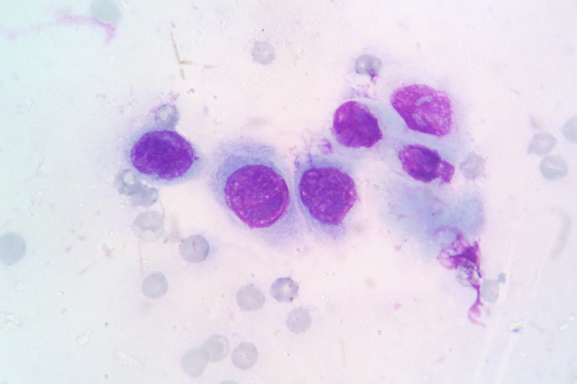 Цитологическая картина плоскоклеточного рака роговицы