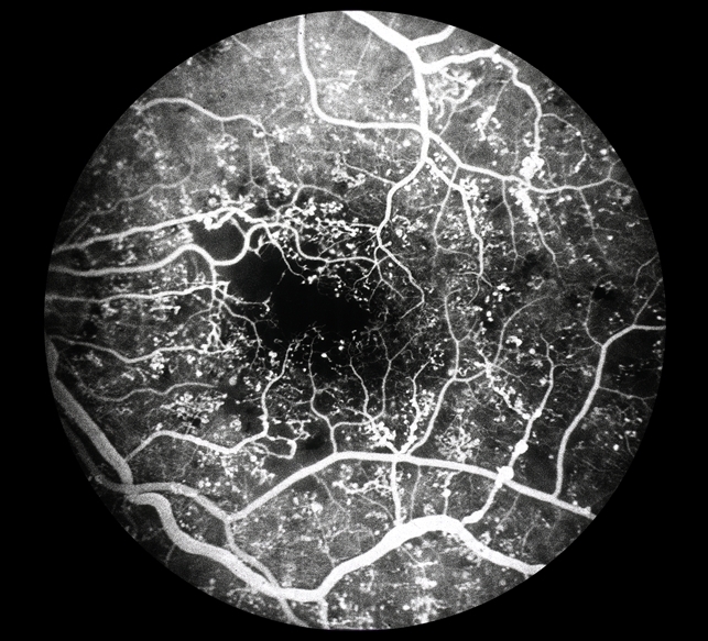 Микроаневризмы при пролиферативной диабетической ретинопатии. ФАГ, ранняя фаза. 
