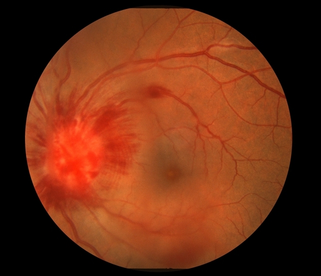 Оптическая нейропатия с интраретинальными геморрагиями при саркоидозе