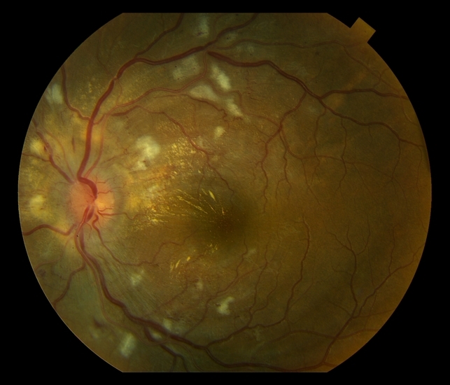 Гипертензивная ретинопатия:макулярный отек, ишемия макулы, оптическая нейропатия, ватообразные очаги мягкого экссудата