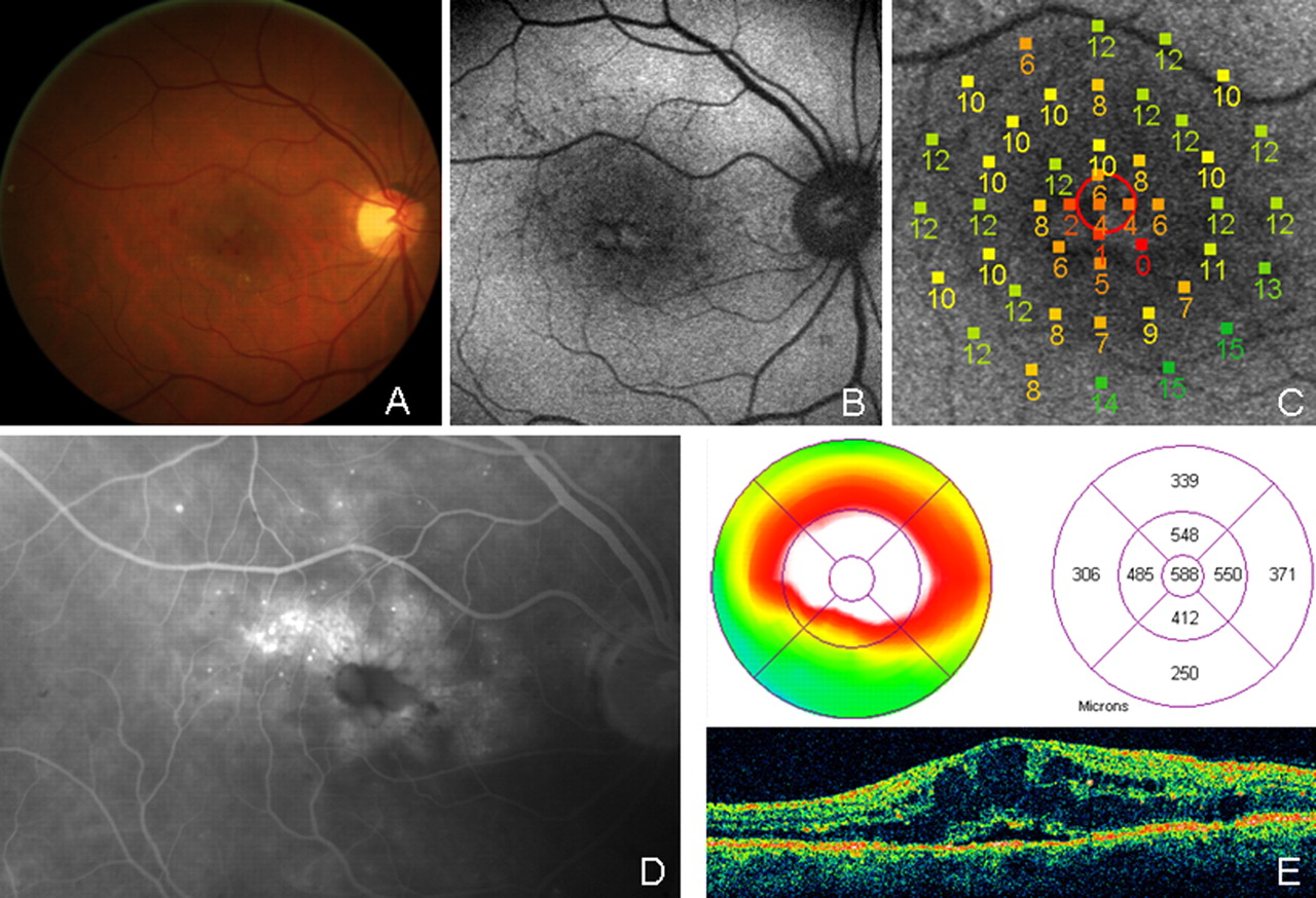 Диабетический кистовидный макулярный отёк (правый глаз): (А) Фото глазного дна; (В) Аутофлюоресценция ; (С) Микропериметрия; (D), Флуоресцентная ангиография и (Е) ОКТ сетчатки