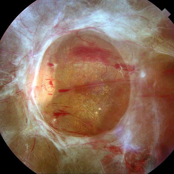 Глиоз при пролиферативной диабетической ретинопатии