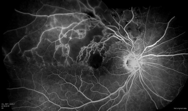 Посттромботическая ретинопатия после окклюзии ветви центральной вены сетчатки 