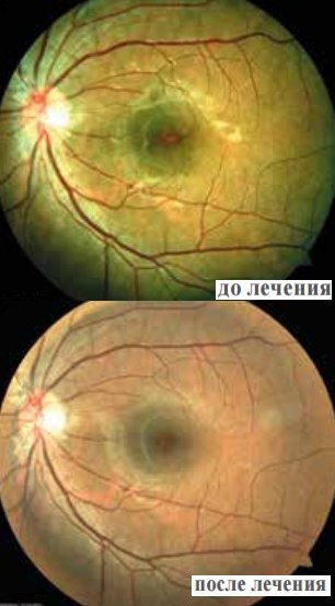 Снимок глазного дна пациентки до и после лечения