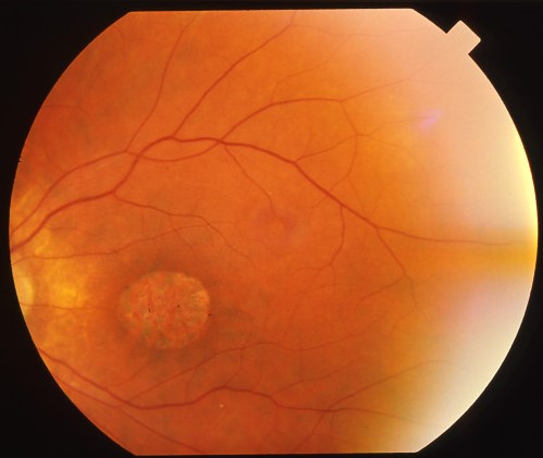 Глазное дно 31-летнего пациента с синдромом Барде-Бидля