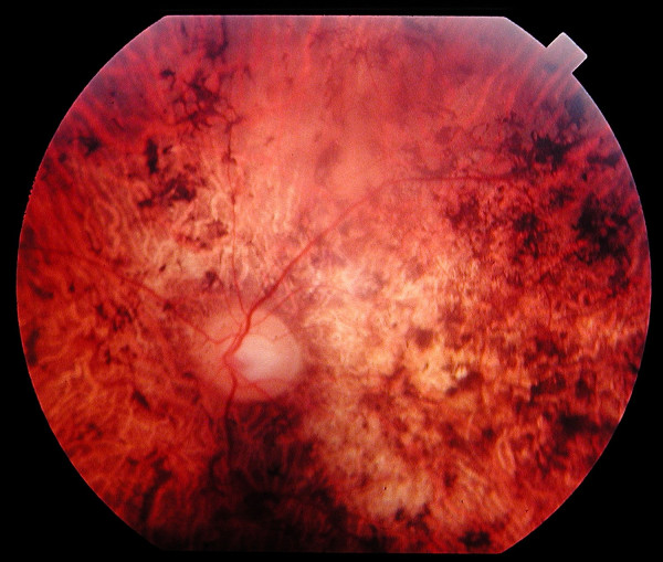 Глазное дно 45-летнего пациента с колбочко-палочковй дистрофией, с мутацией E1087X в гене ABCA4.