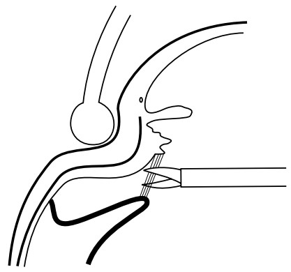 Рассечение цилиоретинальной мембраны ножницами при склерокомпрессии