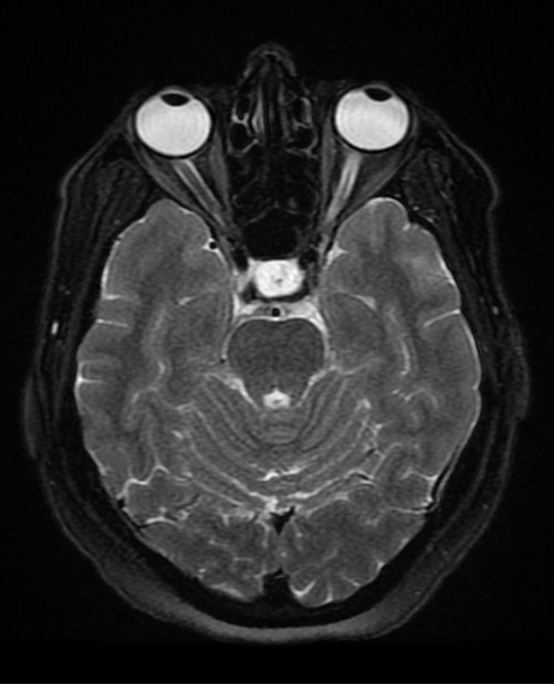  МРТ, атрофия зрительного нерва