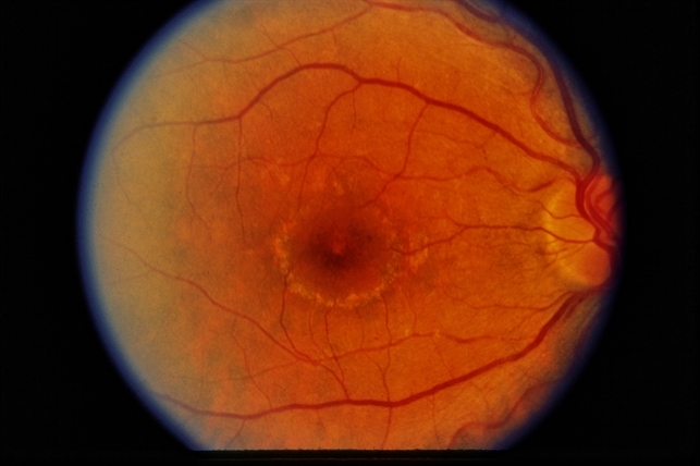 Хлорохиновая ретинопатия