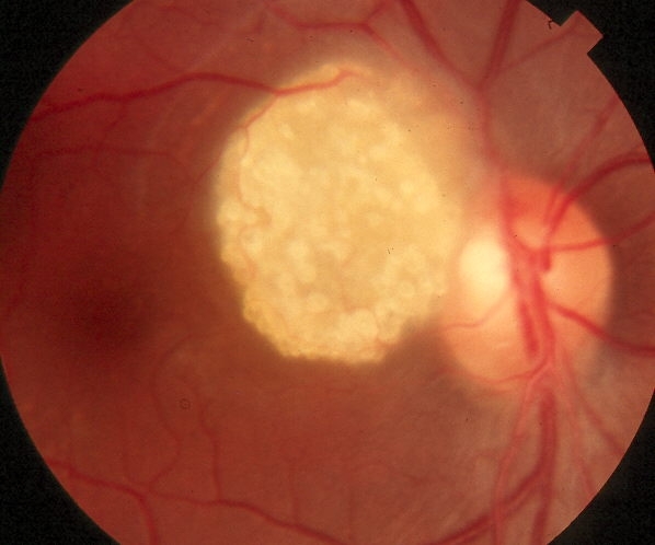 Астроцитома зрительного нерва