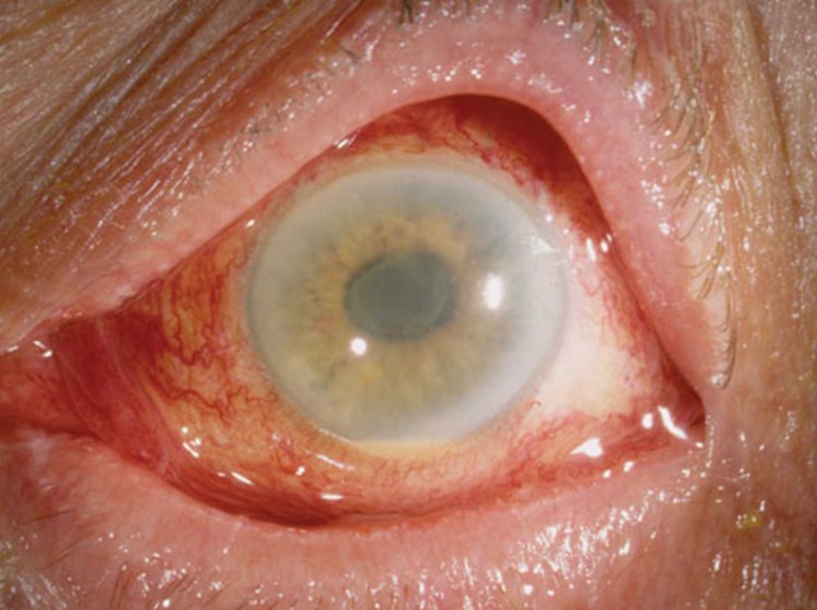 Токсический синдром переднего отрезка глаза