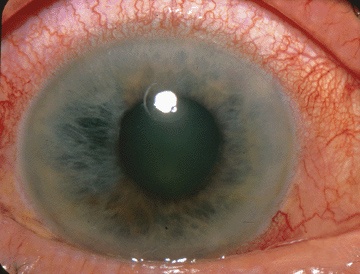 Внешний вид глаза при глаукоме