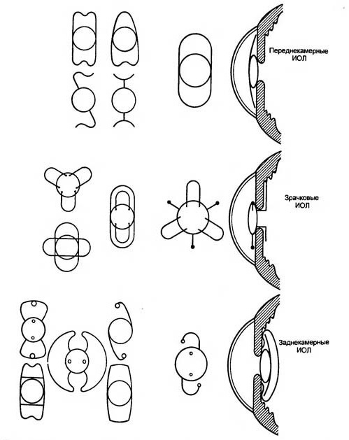 Различные модели интраокулярных линз