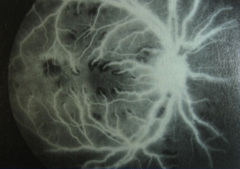 ангиография: выявлено просачивание флюоресцеина из ретинальных сосудов безсосудистой окклюзии