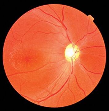 фовеолярный ретиношизис по типу "спиц в колесе"