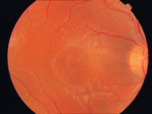 Терминальная стадия фовеолярного ретиношизиса
