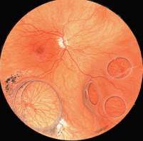 ретиношизис