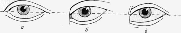 Схематическое изображение глазных щелей и эпиканта:   а — у европейских народов;  б — у народов монгольской расы;  в — при болезни Дауна.