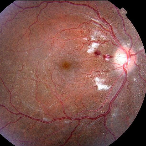 Гипертоническая ретинопатия