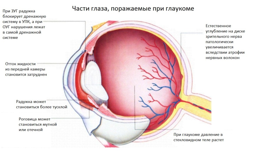 Части глаза, поражаемые при глаукоме