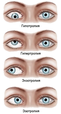 Варианты отклонения глаза