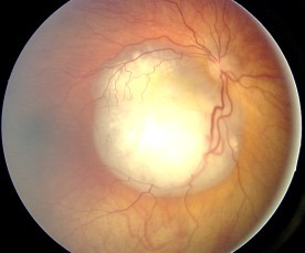 Глазное дно при ретинобластоме