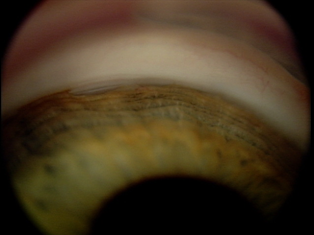 Неравномерный угол передней камеры у ребенка с врожденной глаукомой 