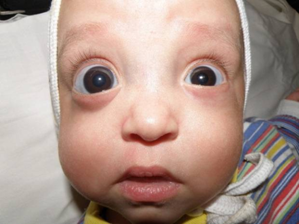 Недоношенный ребенок (32-я неделя гестации) с врожденной II b-глаукомой правого глаза 