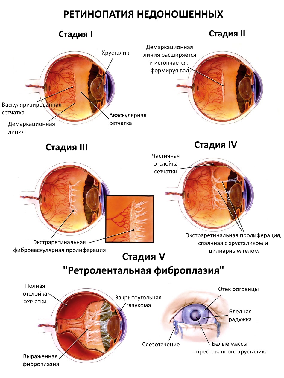 Клиника глаза сетчатки. Ретинопатия 1 степени у недоношенных детей. Ретинопатия недоношенных 5 стадия. Диабетическая ретинопатия стадии. Диабетическая ретинопатия изменения глазного дна.