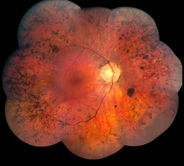 Пигментный ретинит, OD, восковая бледность диска, сужение артериол и костные тельца по периферии сетчатки   