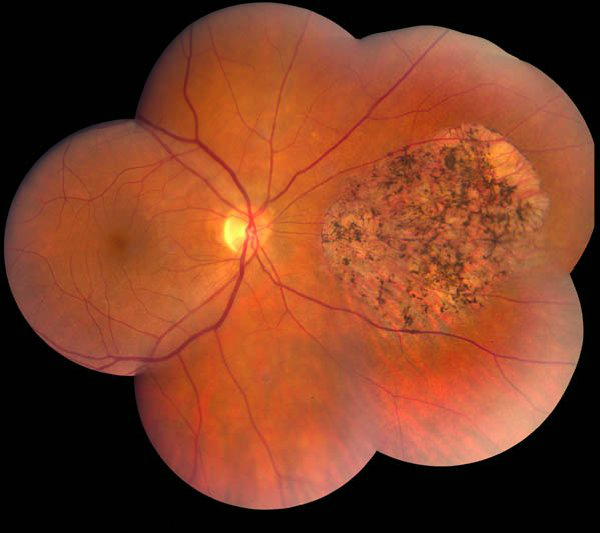Глазное дно при пигментном ретините