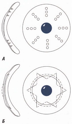 Схема рефракционных операций: а - термокератопластики (точками обозначены термокоагуляты); б - эпикератопластики при гиперметропии