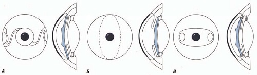 Схемы фоторефракционных операций при имплантации факичных ИОЛ: а — переднекамерных, б — заднекамерных, в — с ирис-фиксацией  