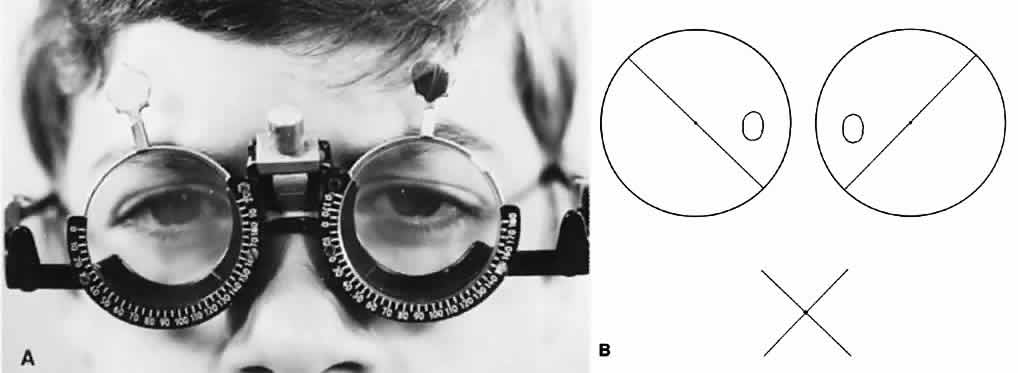 Оценка бинокулярного зрения со стеклами Баголини