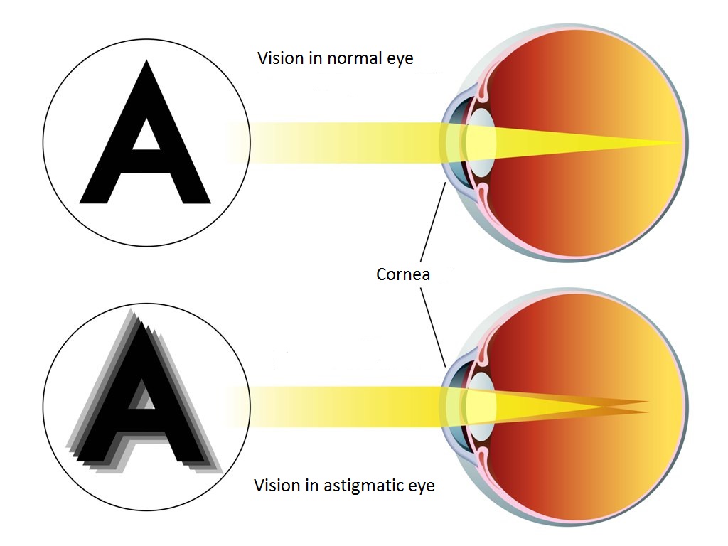 Passage of the rays of the astigmatic eye